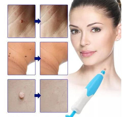 Kit Ferramenta Removedor de Verrugas 2 em 1 Skin Tag - BRvarejo.net